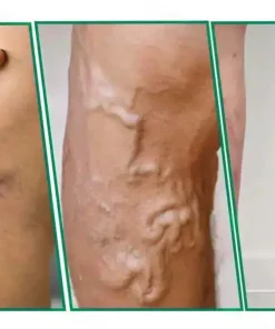 Clearena® VeinTarget Microneedle Patch Once Daily, Visible Results in 7 Days