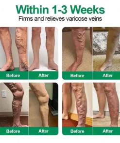 Clearena® VeinTarget Microneedle Patch Once Daily, Visible Results in 7 Days